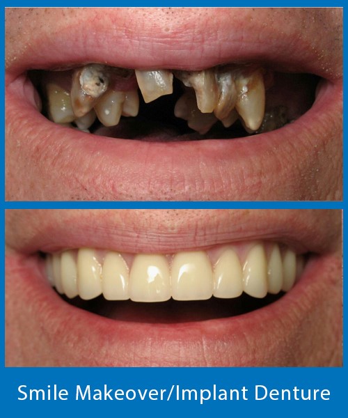 Densurefit For Lower Dentures Lexington KY 40502